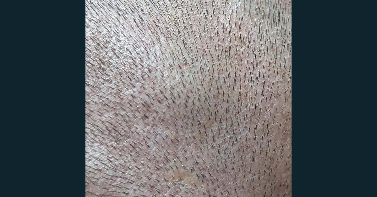Detaliu fotografic al firelor de păr scurte de pe scalp